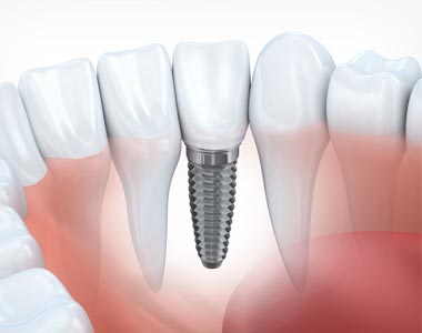 Model of dental implant